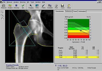Dicas de Dr Ricardo Barbosa sobre Osteoporose, osteopenia e Densitometria Óssea