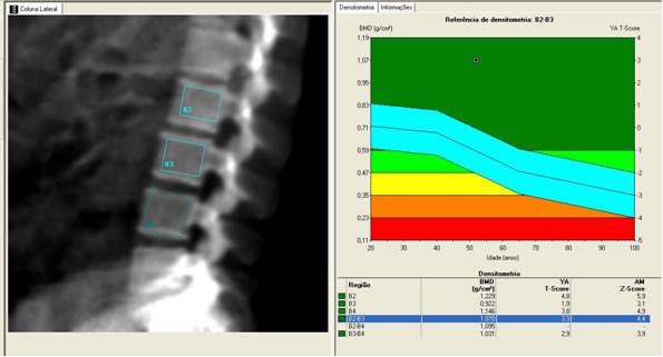 Dicas de Dr Ricardo Barbosa sobre Osteoporose, osteopenia e Densitometria Óssea