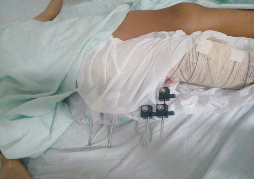 Estudante da rede municipal de Juazeiro é vítima de atropelamento 