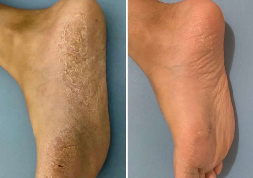 Inovação Estudantil: Alunos Baianos criam sabonete para combater Dermatite