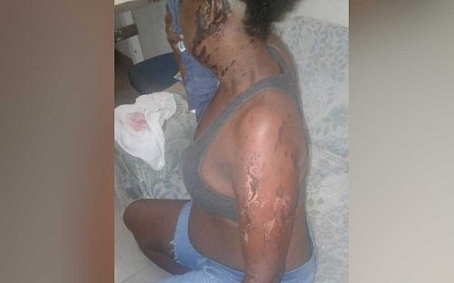 Mulher é atacada com ácido por ex-namorado após término de relação