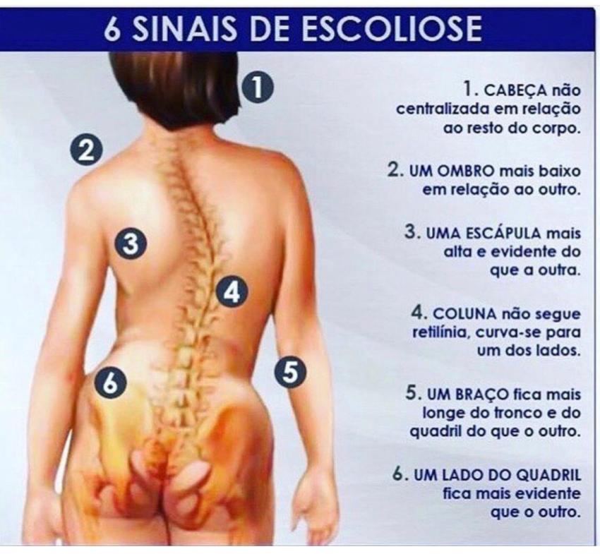 Drº Ricardo Barbosa ortopedista e traumatologista explica sobre os 6 sinais de escoliose