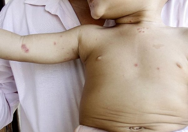 Casos da doença ‘mão-pé-boca’ já são registrados em Livramento
