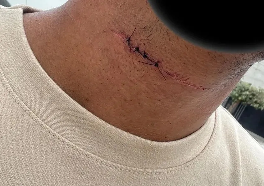 Estudante tem pescoço cortado por linha de cerol em Brumado